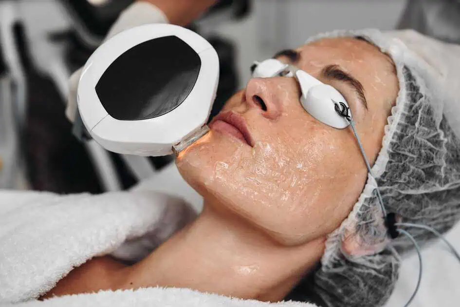 Lumecca IPL Treatment by AESTHETIC CHEMISTRY MEDSPA in Reston Va